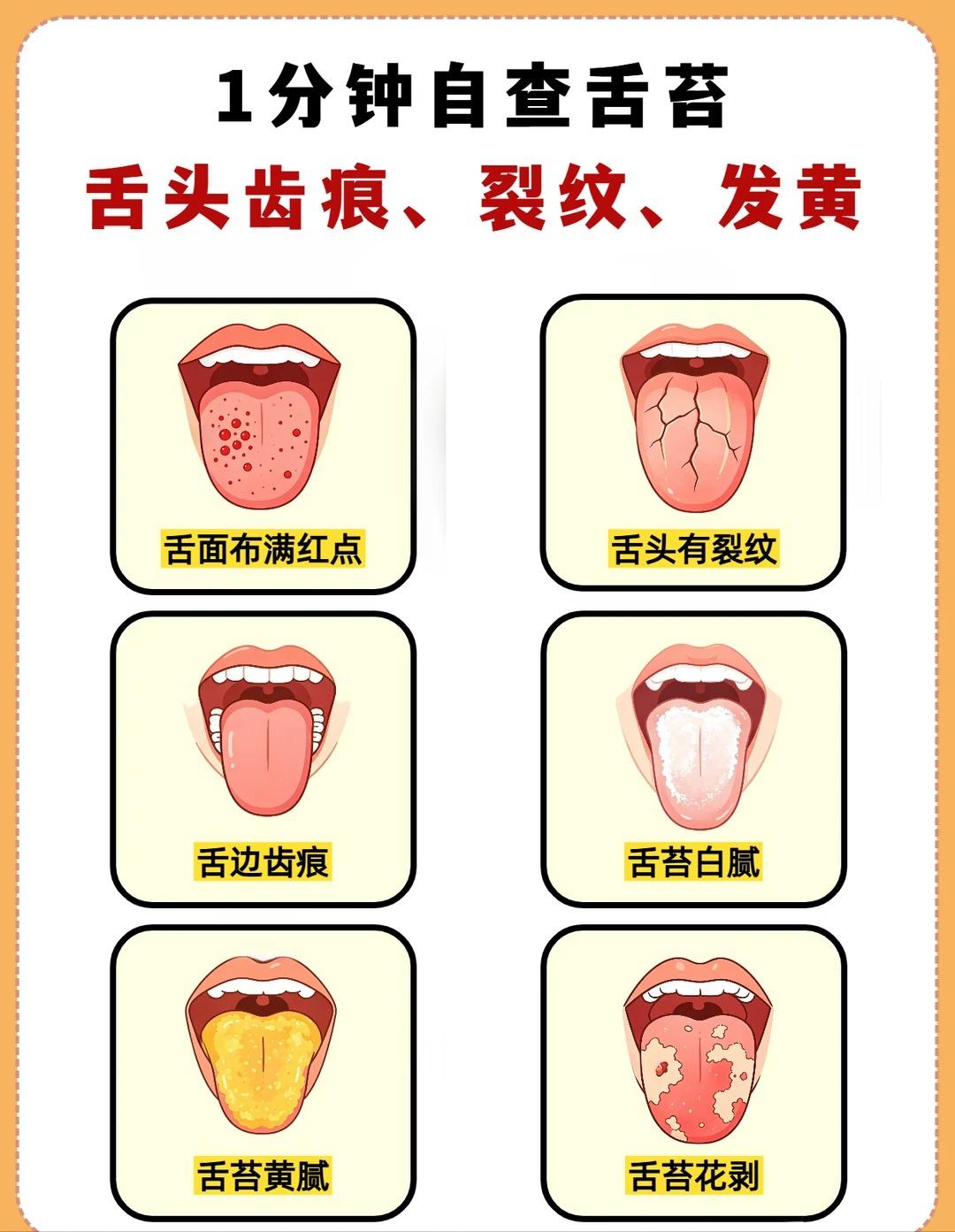一分钟简单自查舌象：齿痕、裂纹、舌苔发黄分别代表什么