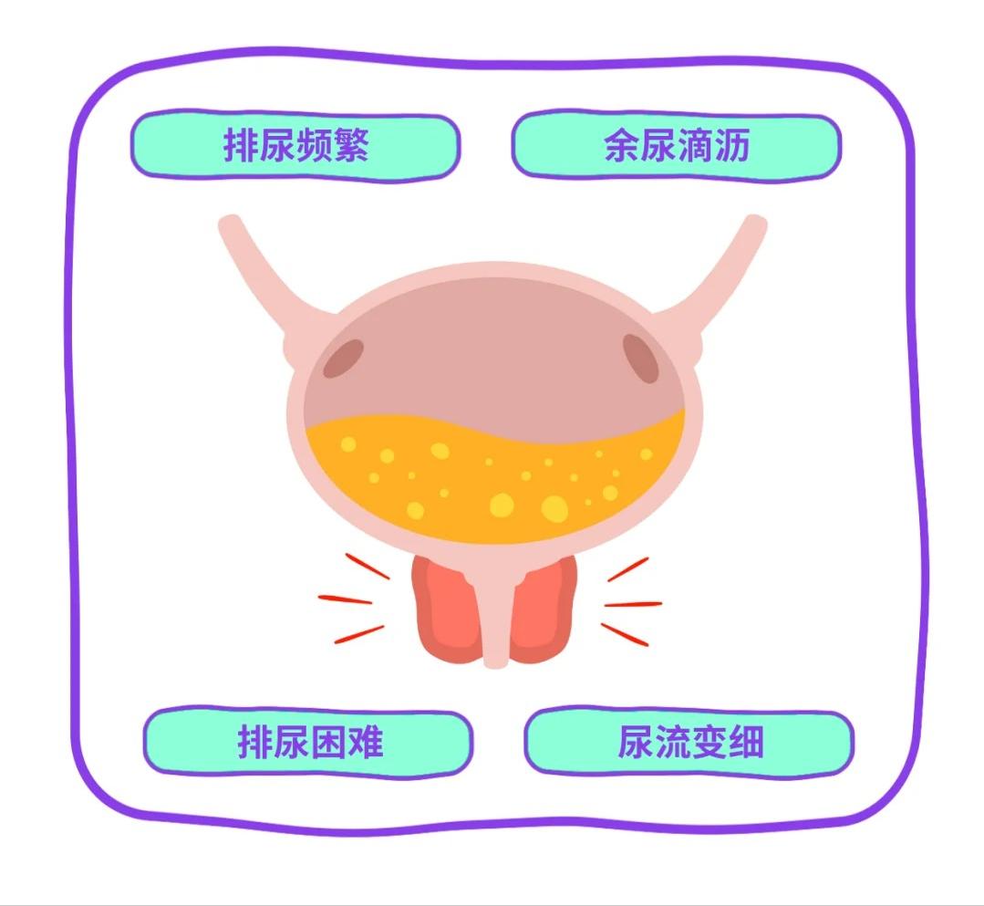 前列腺增生有啥表现？4个症状要留意！