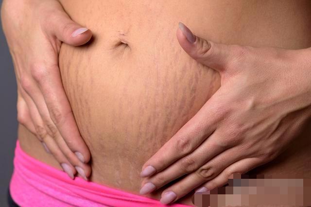 孕妇如何淡化妊娠纹? 试试这几个小方法