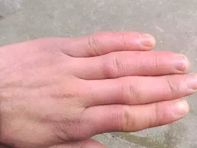 要警惕“冻”出来的皮肤病, 这些细节你“不得不防”!