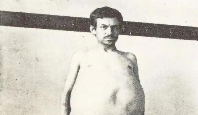 1940年，美国男子约翰因严重便秘长达三年，最终因排泄困难导致身体崩溃而去世。医