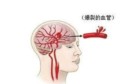 高血压出现这2个症状, 说明中风要来了! 第2个最明显