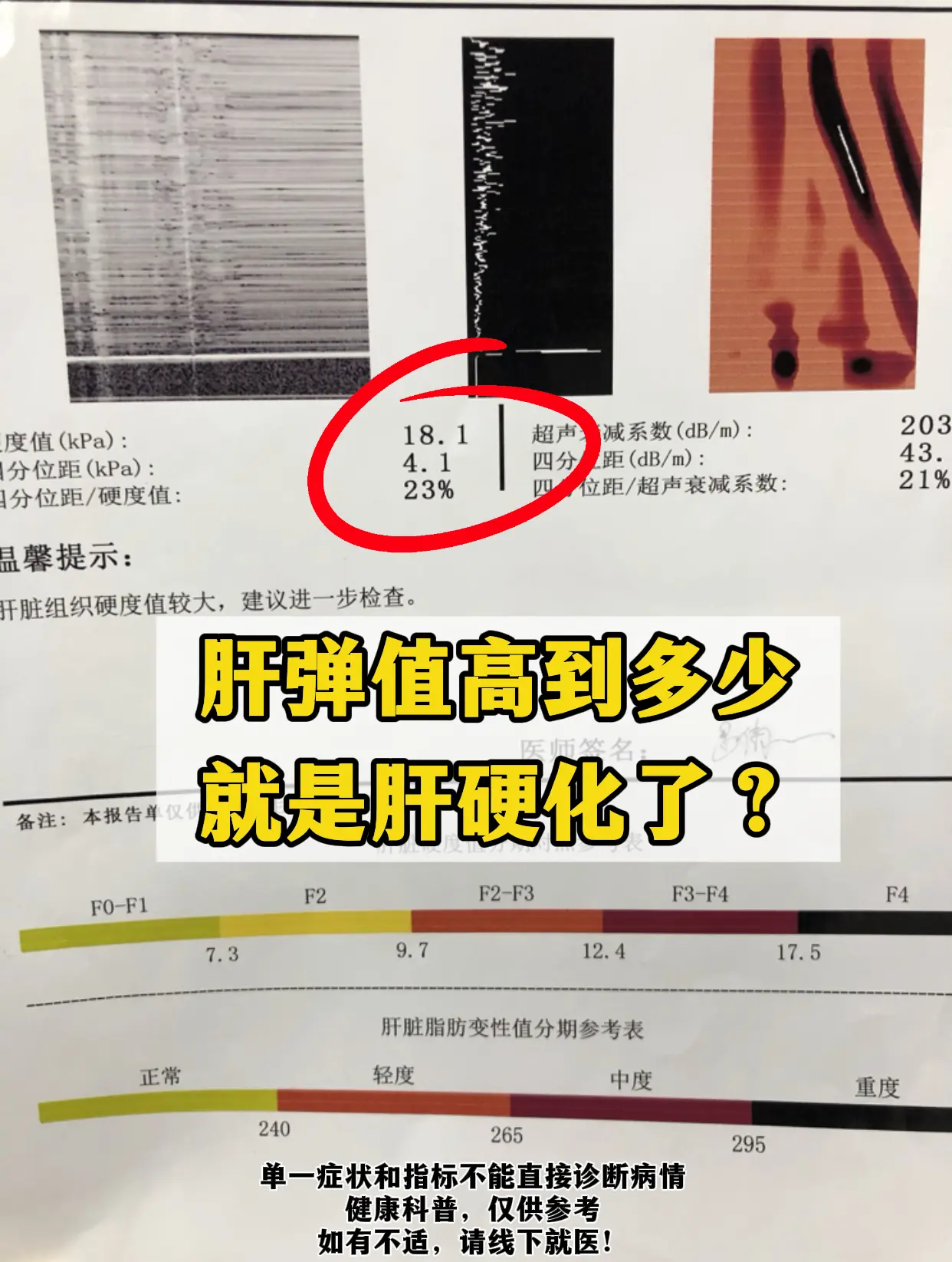 昨天一位济南本地的乙肝患者咨询：教授，我的肝弹 18.1，是不是已经肝...