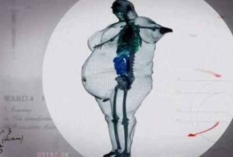 900斤男子手术减肥后拍X光, 医生看后害怕了