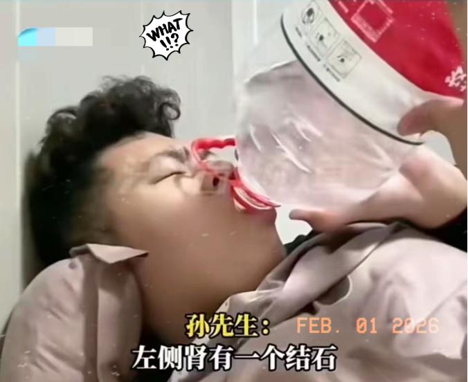 真是一个狠人啊！小伙为了省12000手术费，每天喝五升水，结果尿出9毫米结石！小