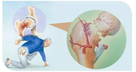 如发现x线片有钉痕出现,股骨头高度递减和硬化透明带等现象,表明股