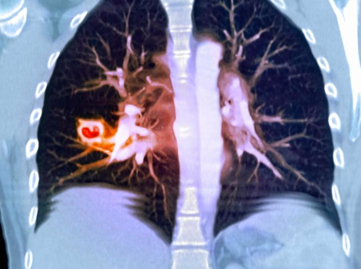 一个便宜的中成药，专清肺里的痰和瘀，结节一天比一天小肺里有东西卡住了——痰堵、