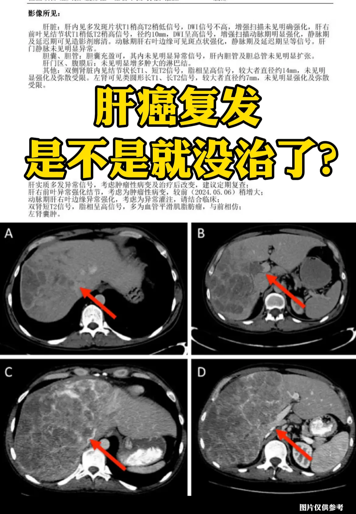 肝癌复发是不是就没治了？。很多肝癌患者一听到“复发”两个字，当场就崩溃...