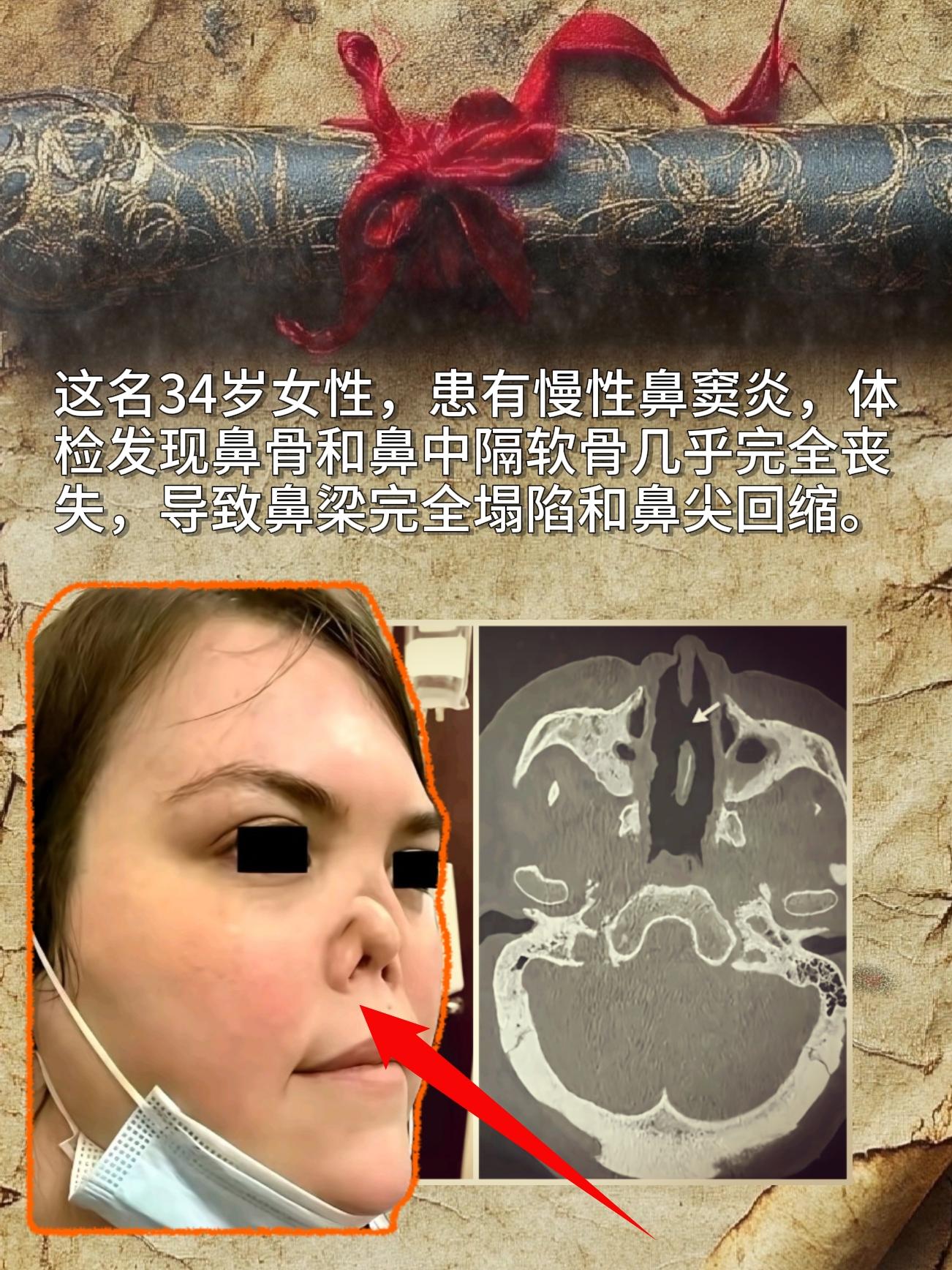 很难想象鼻骨和鼻中隔软骨几乎完全丧失，导致鼻梁完全塌陷和鼻尖回缩。