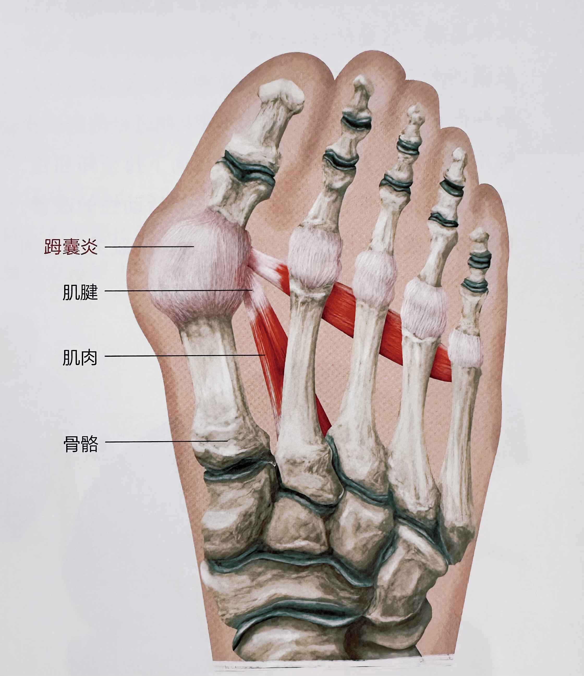 足踝疼痛除了足底筋膜炎，足踝还有哪些常见损伤？①小腿拉伤②跟腱病（跟腱撕