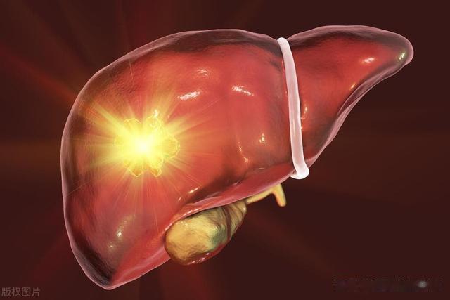 肝功能正常, 半年后确诊肝癌晚期? 医生: 筛查肝癌这4项检查别省