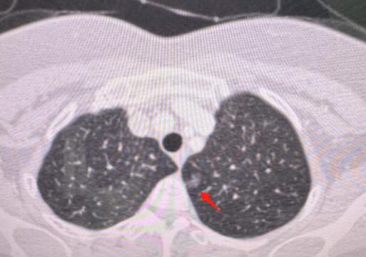 科普做得好＝手术差？我用两台一模一样的肺结节手术，说句大实话！刚连做两台肺小结节