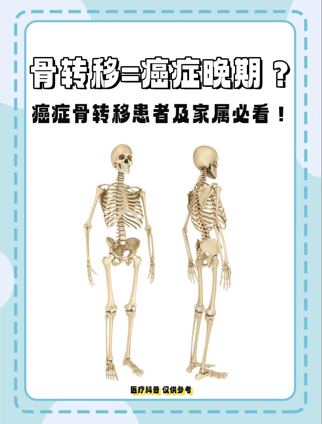 骨转移就是癌症晚期？当“骨转移”三个字出现在诊断报告上，许多患者和家属的第一反