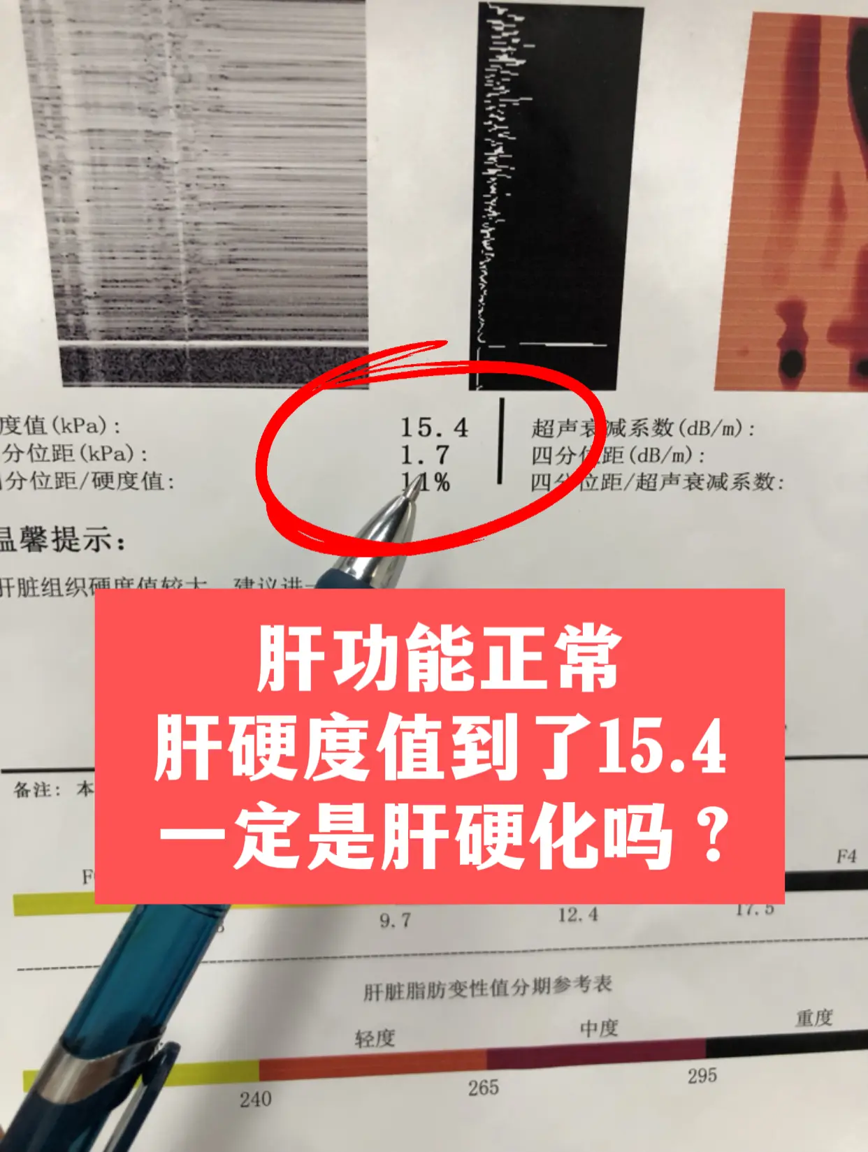 有朋友线上询问：教授，我肝功正常，肝硬度却到15.4，平时有点乏力，是...