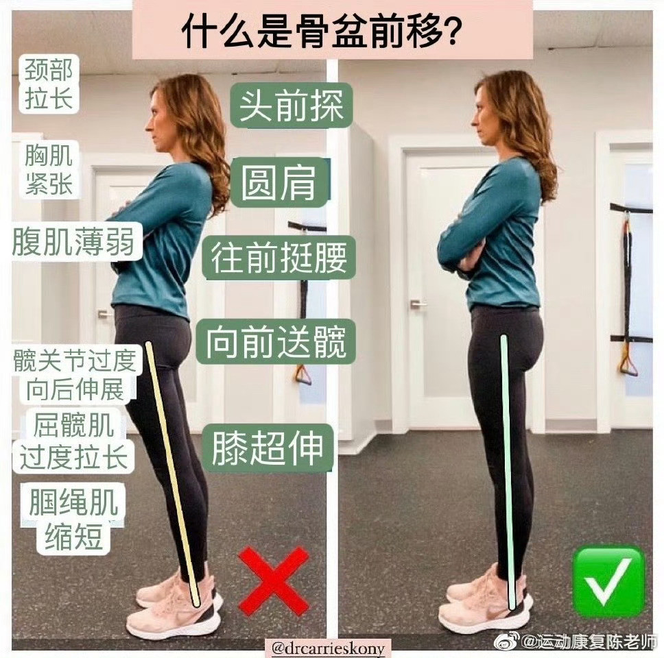 腰痛这个姿势我猜一半的朋友会有——骨盆前移👉骨盆向前移动，挺肚子，容易腰痛?