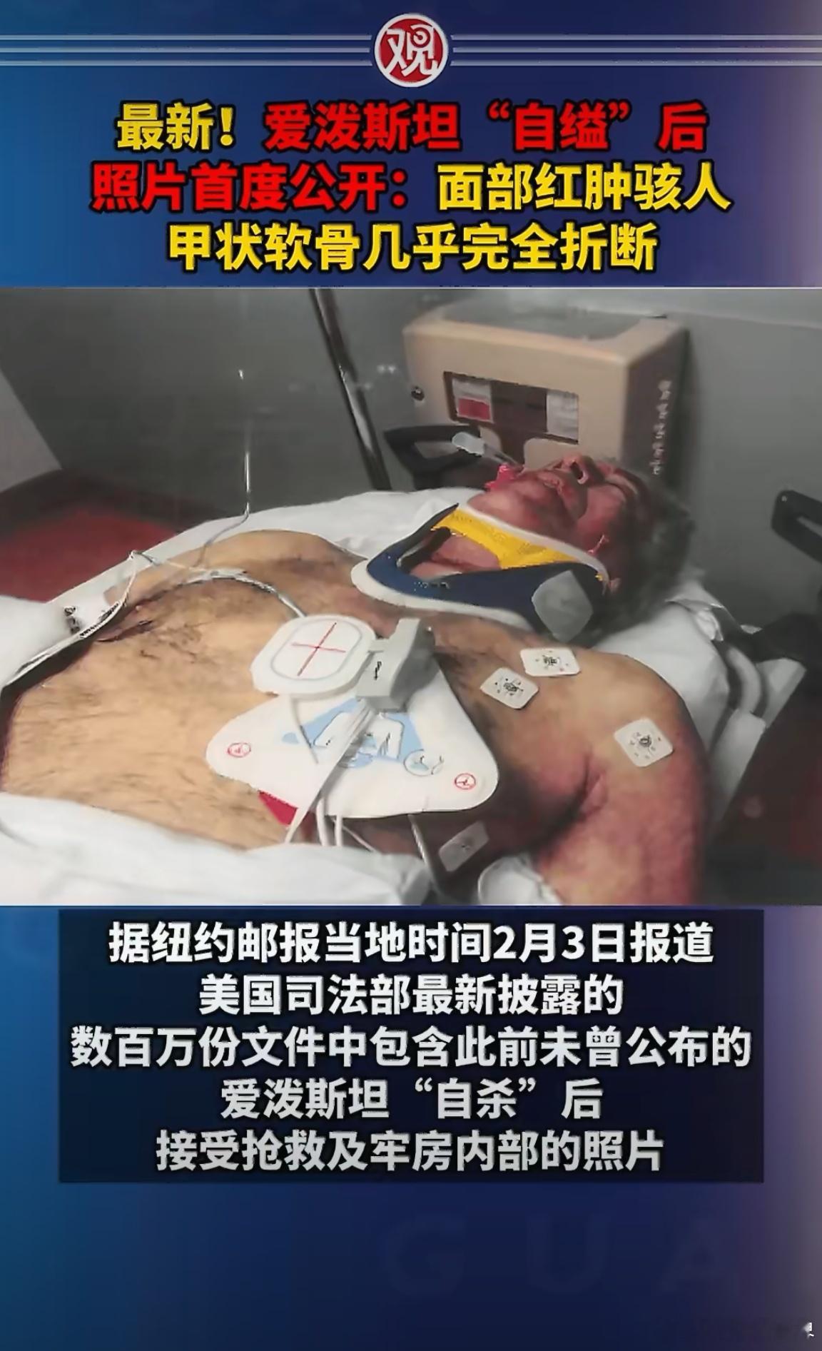 爱泼斯坦自缢后甲状软骨几乎完全骨折由此可见，爱泼斯坦背后的力量有多么强大！是共济