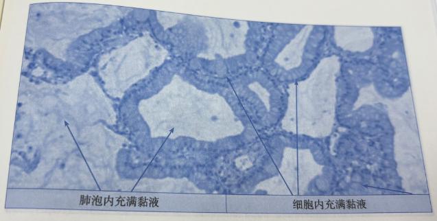 最近很多朋友在问我，什么是肺黏液腺癌？它与肺原位癌有什么区别？其实简单来说，就是