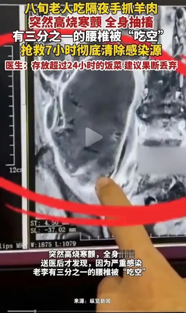 谁能想到?西安82岁老人一顿“剩菜”吃出大问题,不仅高烧抽搐进了医院,连腰椎都被