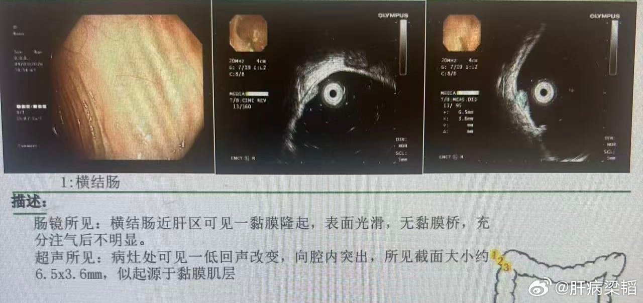结肠息肉在超声肠镜（EUS）下的核心描述：起源黏膜层、边界清、回声均、壁层完整、