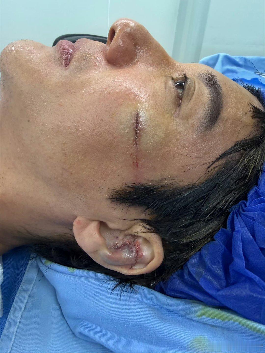王力宏缝了39针原来脸上也有这么长的伤口，太不容易了！！我看着都觉得疼。
