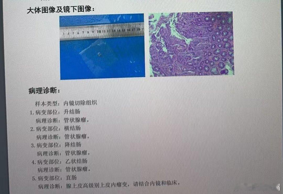 大肠里面，O-IIc凹陷病变，癌症风险更大。