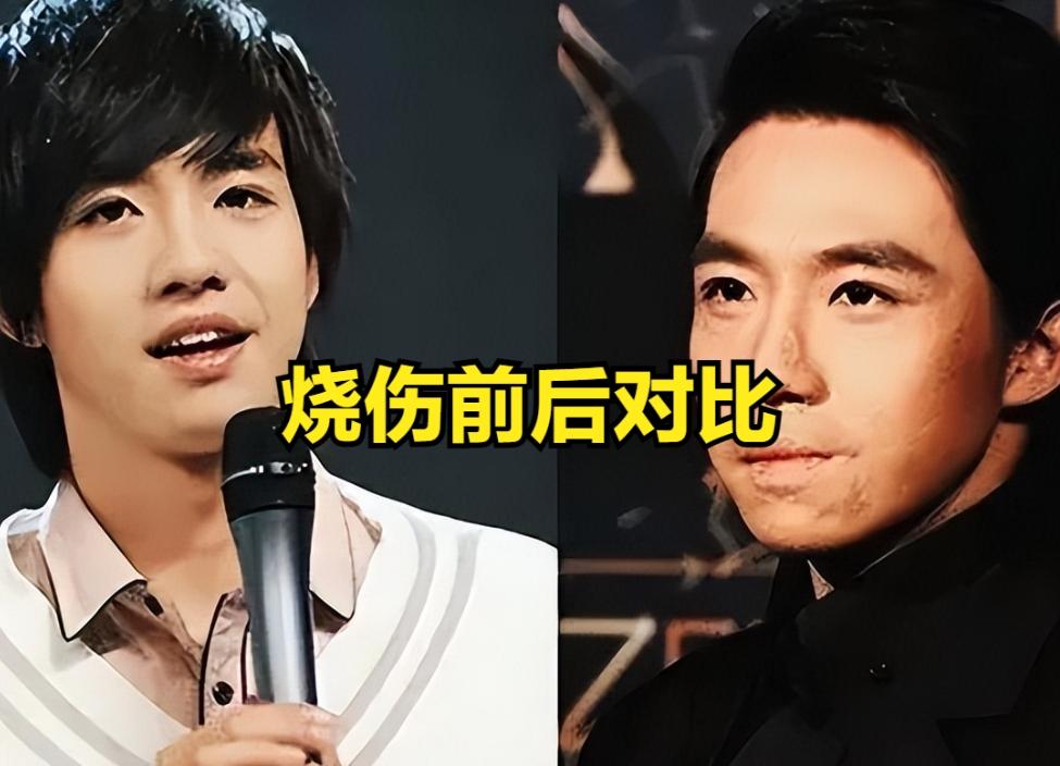 俞灏明说：我被烧伤后，开始大家都对我挺热情的，受伤的过程中也很关心我，但是我好了