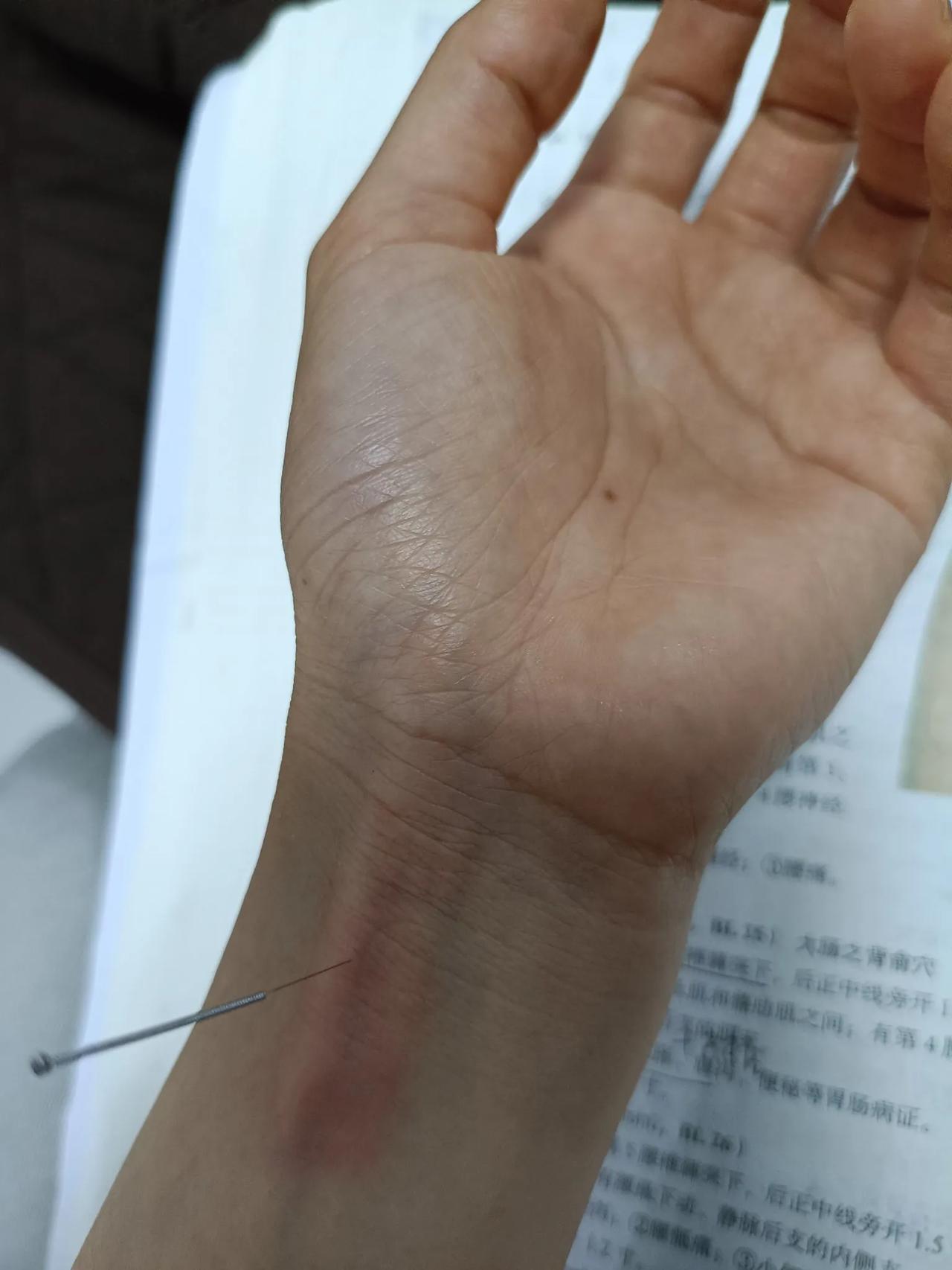 这效果也太神奇了吧！第一次亲自感受到针灸的神奇之处。刚才上课中途休息期间我接了