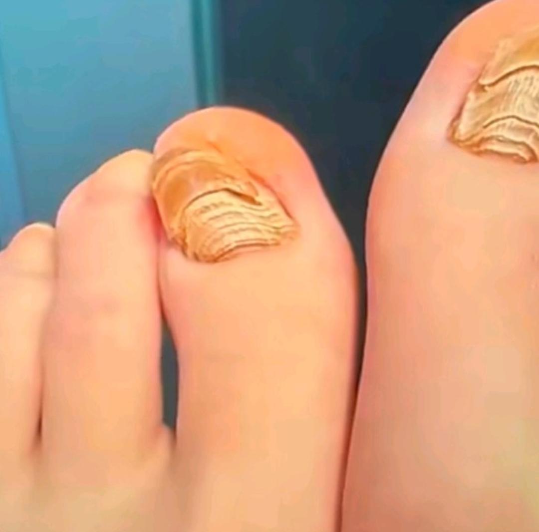 26岁女子穿袜子睡觉，睡出千层甲杭州有个26岁的女生，一直都习惯穿着袜子睡觉