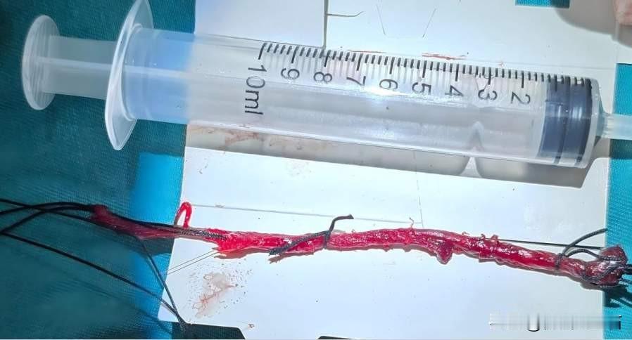 最近看到一则奇闻，厦门15岁少年小超脖子上长“鱼鳃”，其实是鳃裂瘘管。在闽南，这