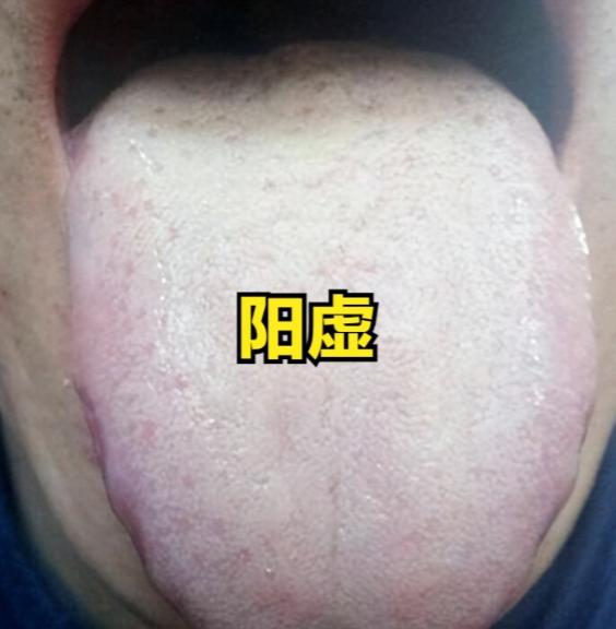 便稀黏腻粘马桶？别只祛湿！是脾胃阳虚缺“火力”大家好，我是中医陈大夫！好多