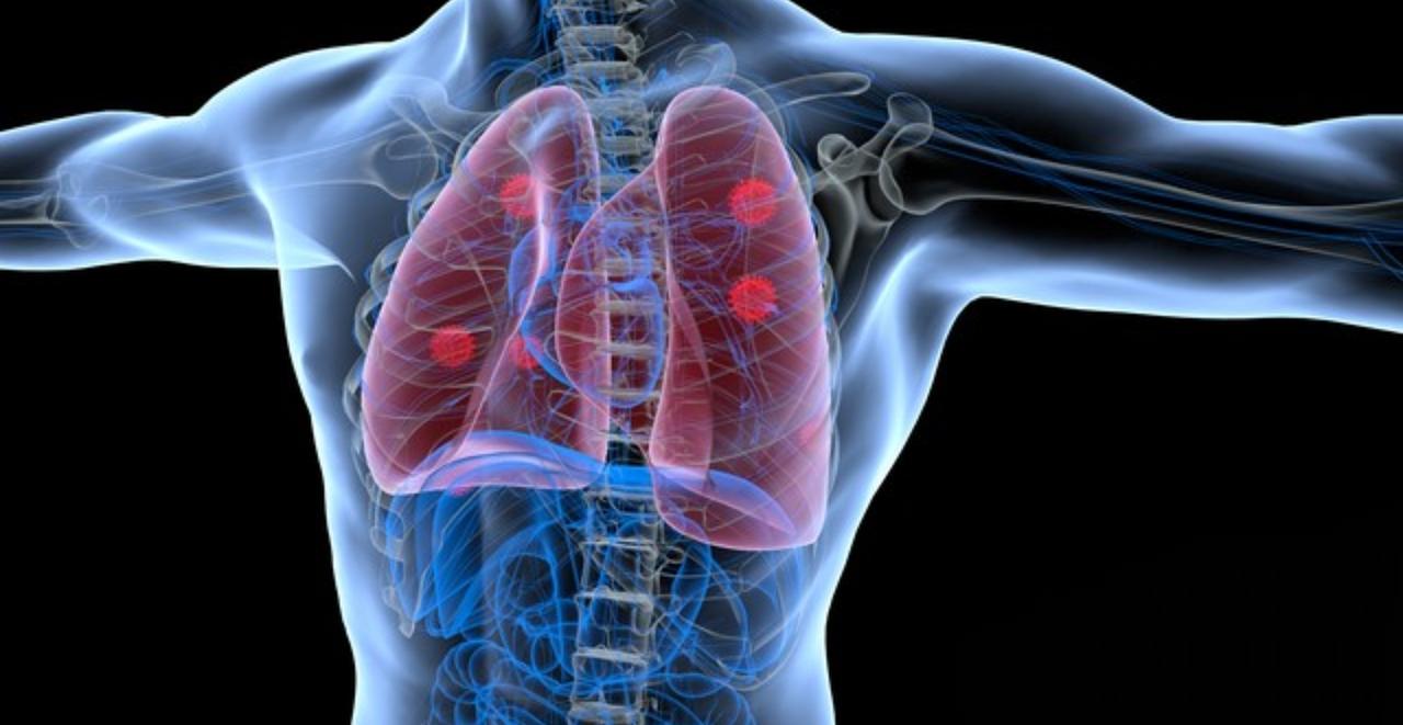 晚期肺癌到底有没有根治的案例，可以说这世界上任何事情都有例外，普遍认为晚期肺癌不