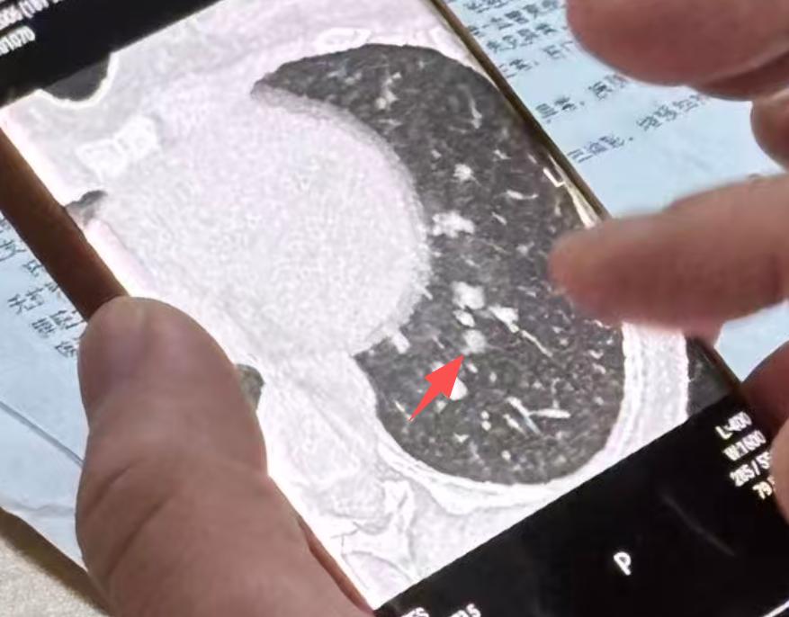 周一看了50个门诊，并且排了6台手术，趁着中午休息时间，抓紧时间和大家分享一个病