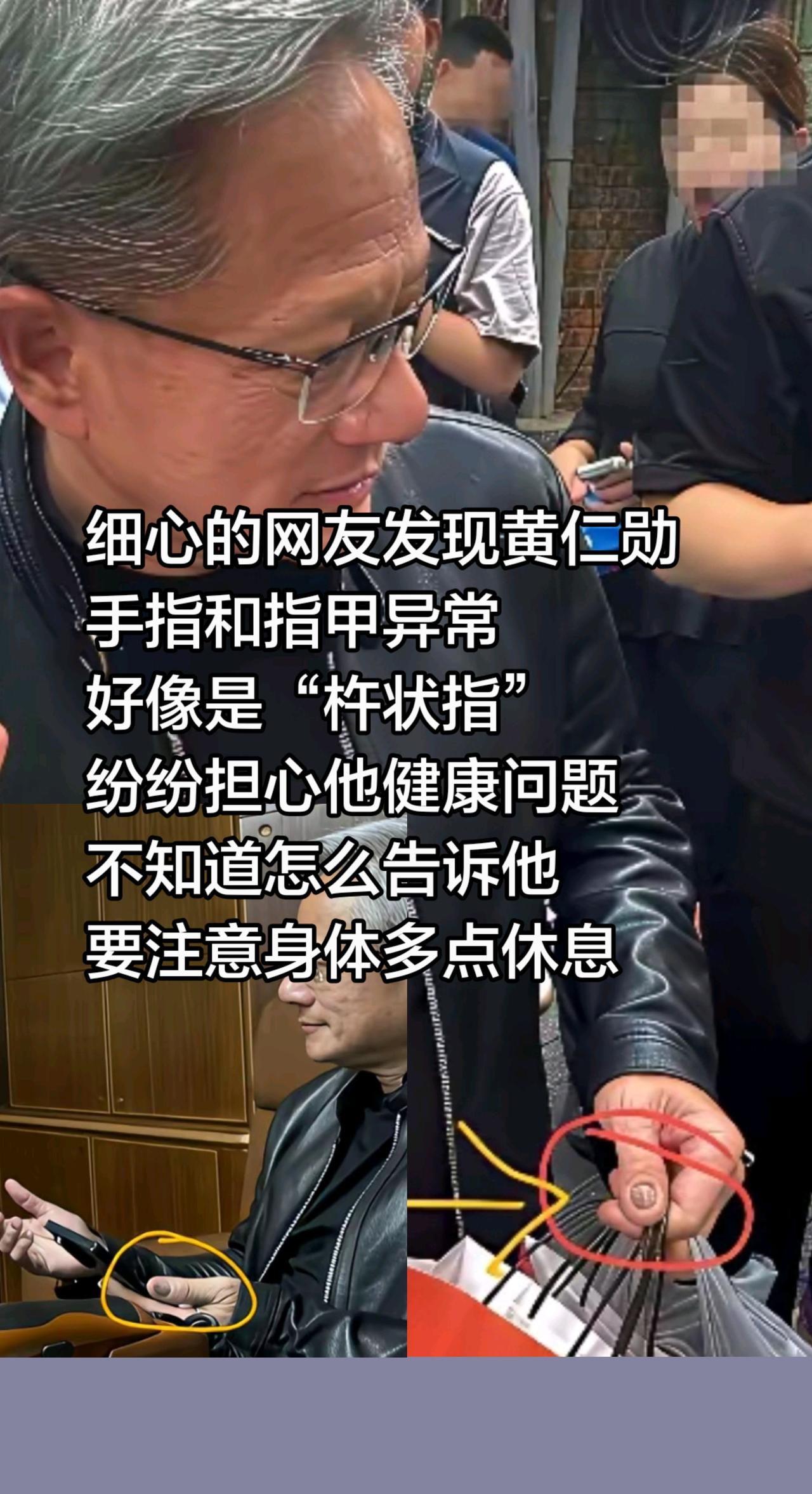细心的网友发现黄仁勋手指和指甲异常好像是“杵状指”纷纷担心他健康问题不知