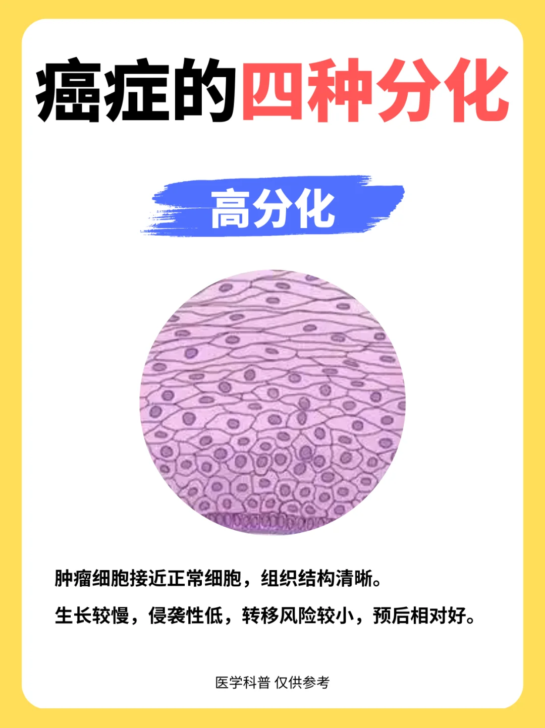 癌症的四种分化