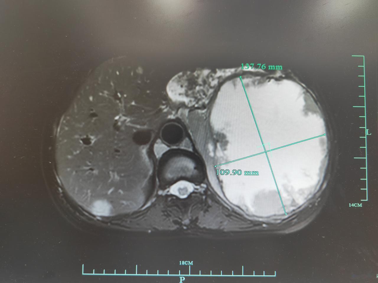 确诊胰腺癌,如何绝处逢生?这是我们7月底治疗的一名巨大胰腺囊腺癌，病人治疗前肿瘤