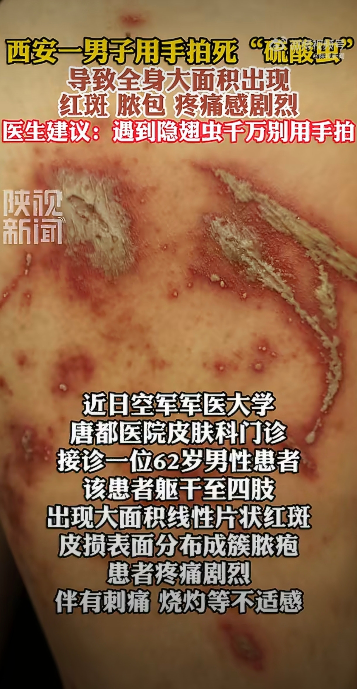 近期，一则男子随手拍碎身上的隐翅虫，最终导致全身皮肤溃烂的新闻在网络广泛传播，引发大量网友关注和转发