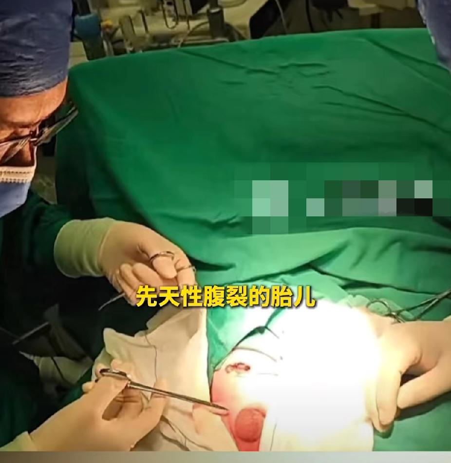 生命的奇迹！2月25日，河南郑州一孕妇剩下一位先天性腹裂婴儿，胃肠道等器官暴露在