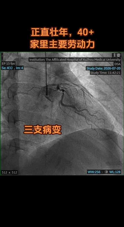 基因不好，命不好。40+男性，无高血压糖尿病，无血脂异常，筛查无结缔组...