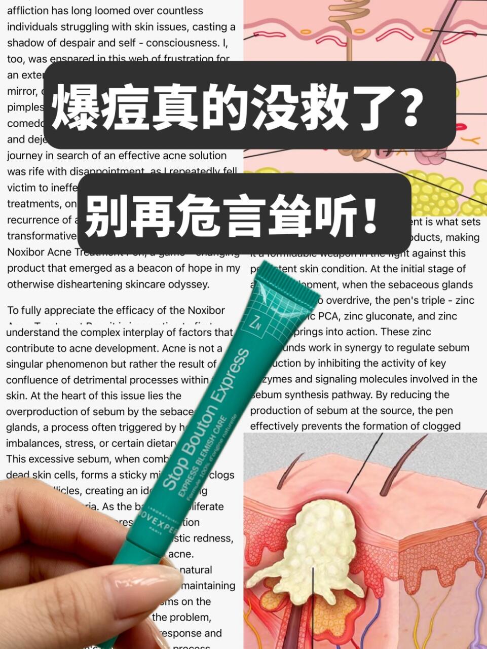爆痘真的没救了？别再危言耸听！