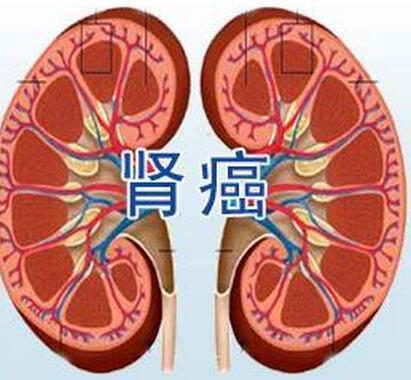 肾癌与肾盂癌该如何鉴别