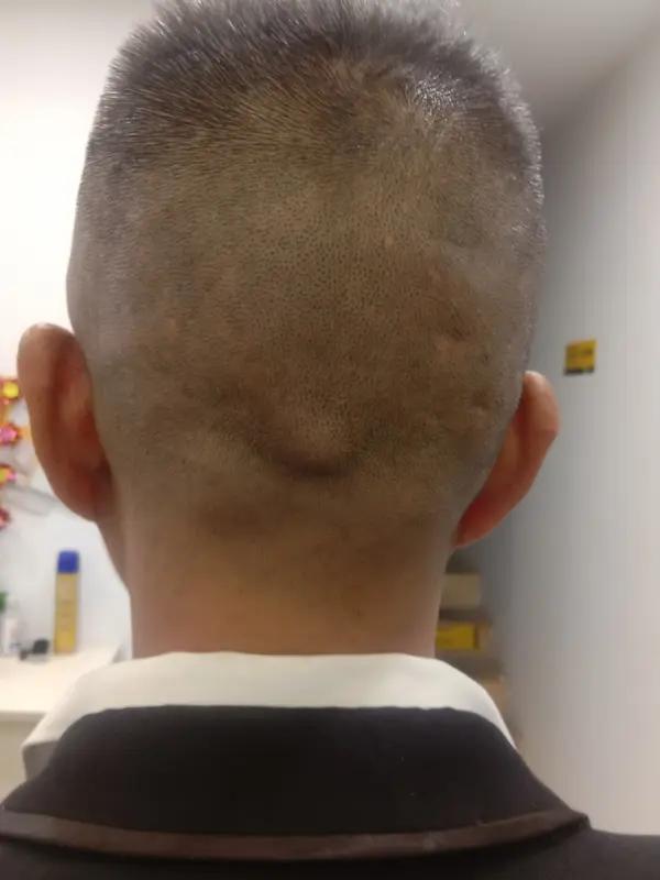 右后脑勺一阵一阵刺痛可太折磨人了。这可能是由多种原因导致的。比如紧张性头痛，精神