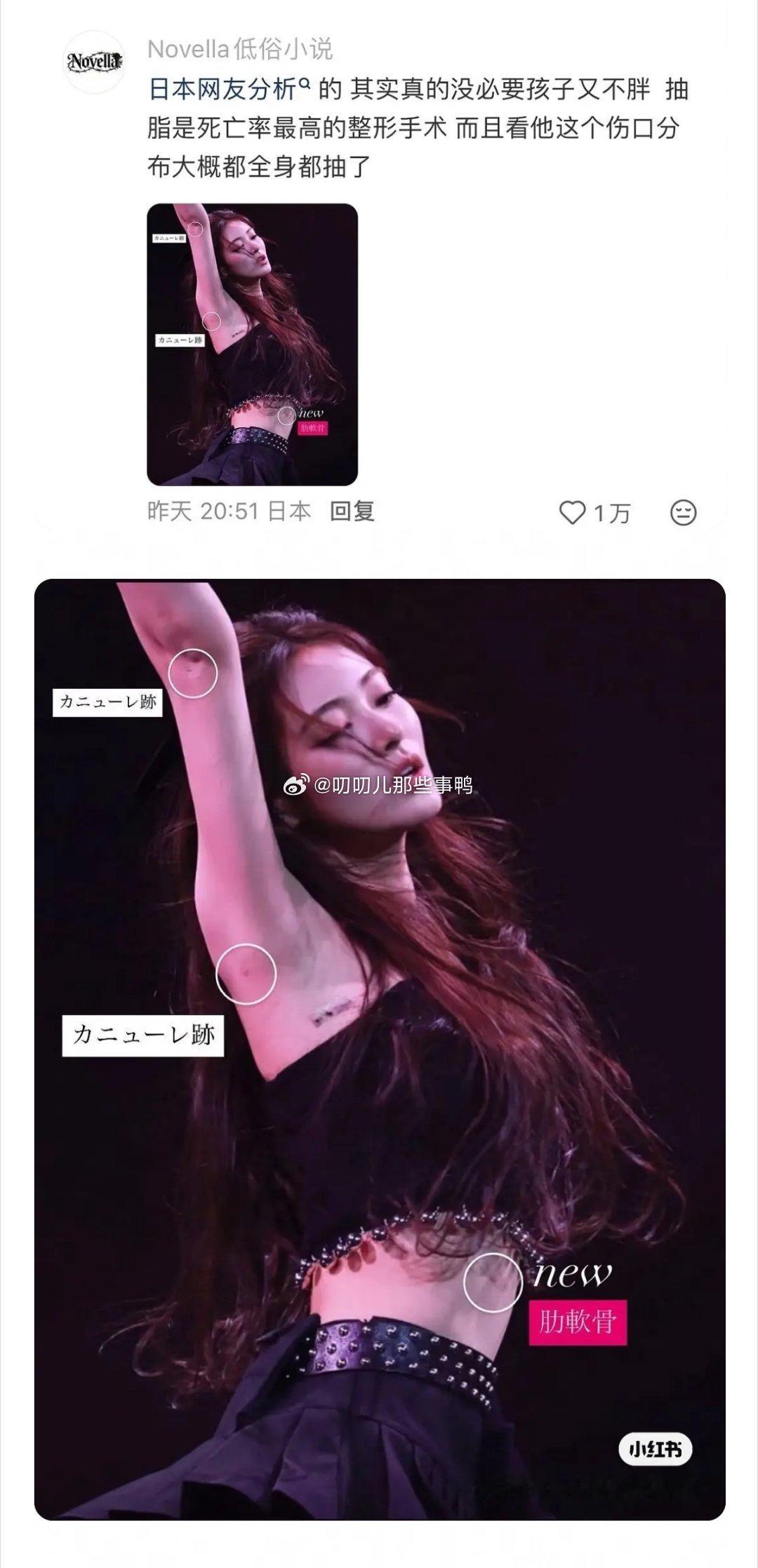 我的天，这是吸脂的手术口？