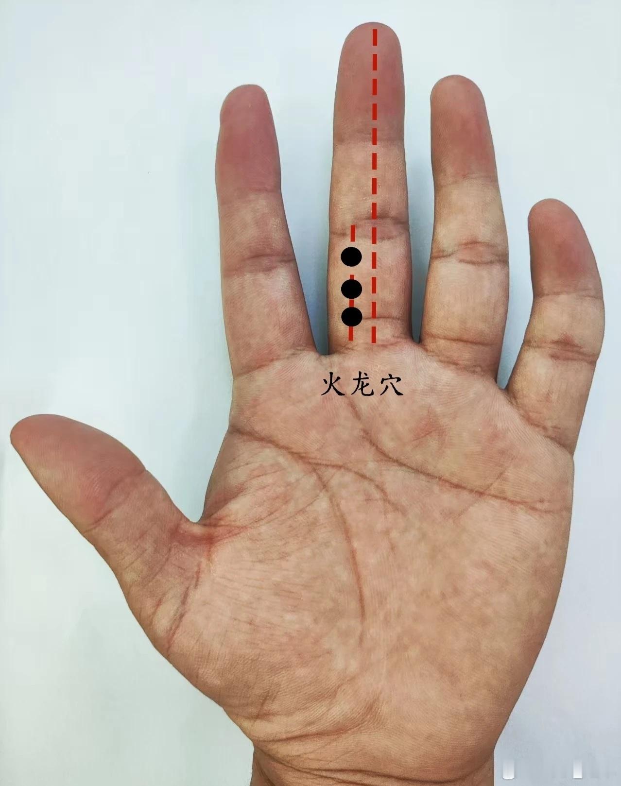 胸闷胸痛火龙穴源自董氏奇穴位置：在手掌面，中指第一节中央偏食指侧三分线上，三点