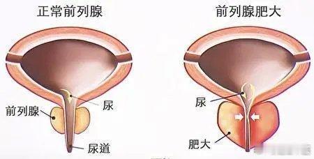 偏方治大病；前列腺增生，炎症验方；1，玉米须50克，车前子20克（布包），生甘草