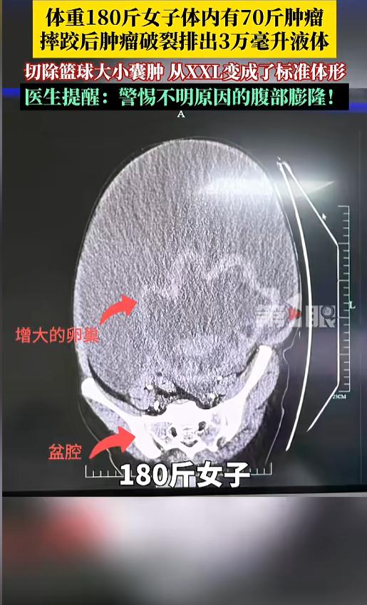 “离大谱！”浙江女子减肥多年，180斤体重纹丝不动，没想到摔了一跤后，肚子突然“
