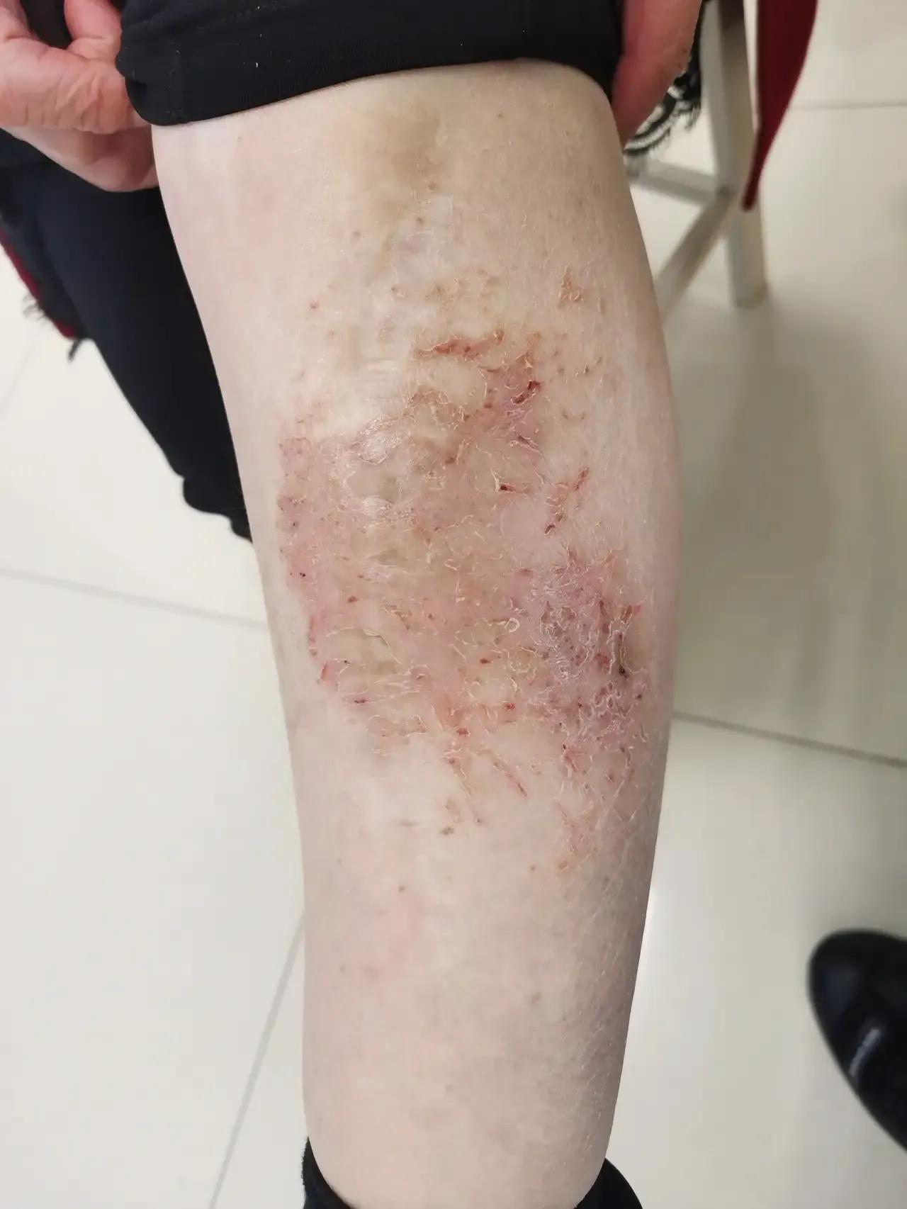 最近关于武大的事闹得沸沸扬扬，其实一切的根由全都怪湿疹引起的，我来讲讲这个湿疹是