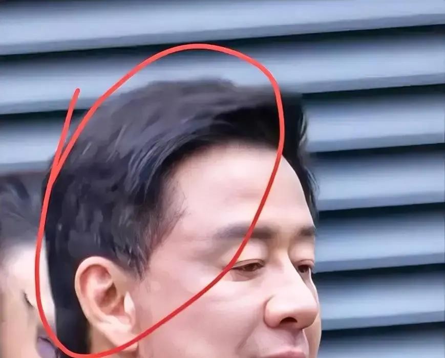 杨坤最近上综艺，那头发黑得发亮，发际线还往前拱了拱，跟三年前那个亮着大额头的样子简直判若两人这事儿其