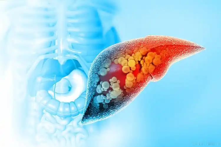 忽视肝硬化预警信号，延误最佳治疗时机接诊的一位60岁，有15年乙肝病史，5年