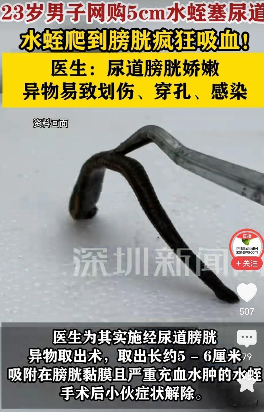 出于什么猎奇心态，居然拿水蛭塞尿道，这小伙子长点心吧。1月6日，郑州人民医