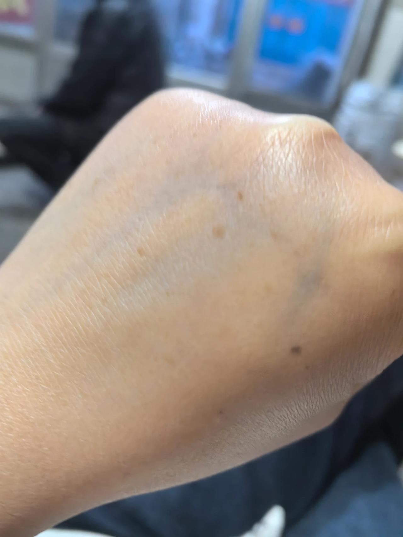 刚刚过了不惑之年，40多手上就开始有老年斑了今天忽然发现，手上有一个个斑点，四